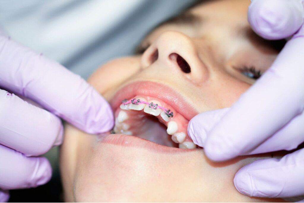 child braces