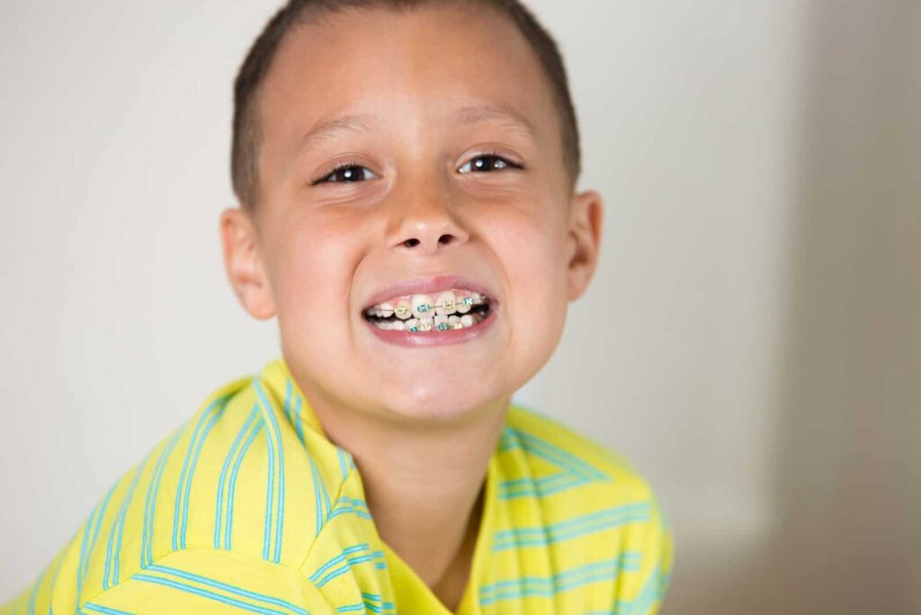 Does My Child Need Braces? Early Signs to Watch For 1 Braces