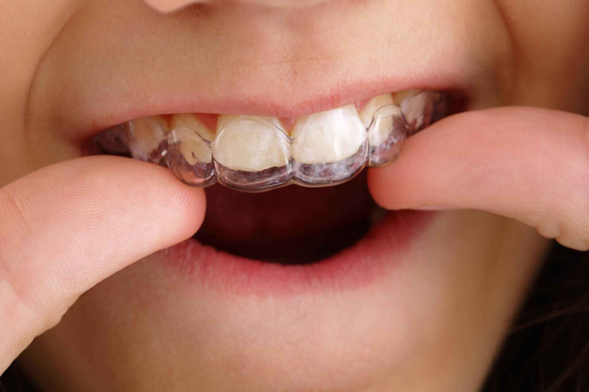 Aligners Img