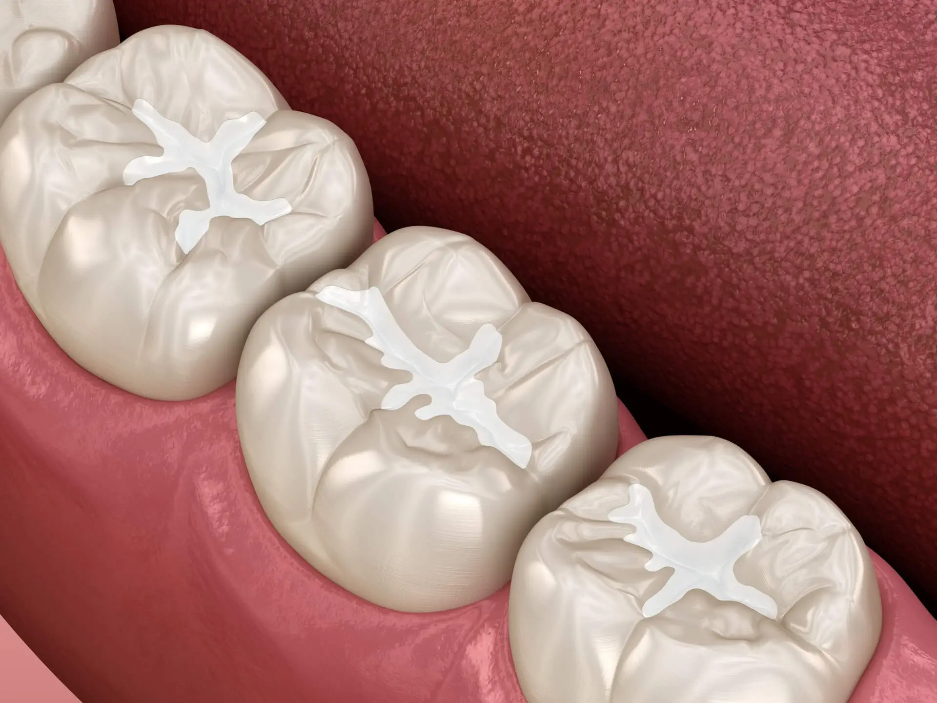 dental sealants methuen