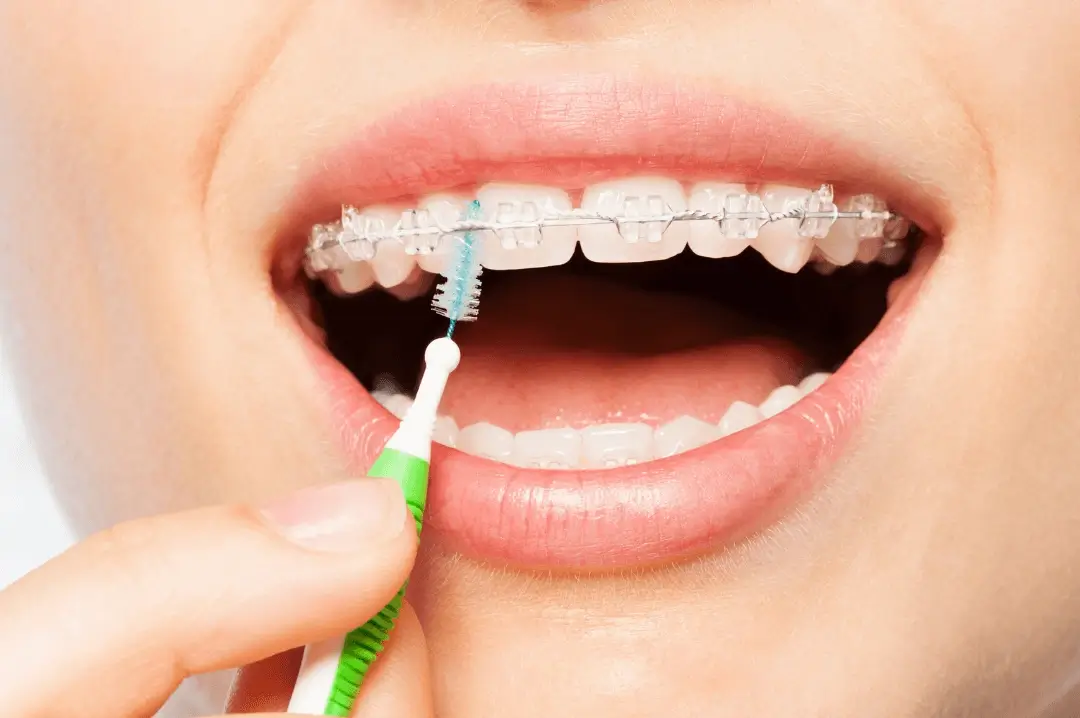 ceramic braces
