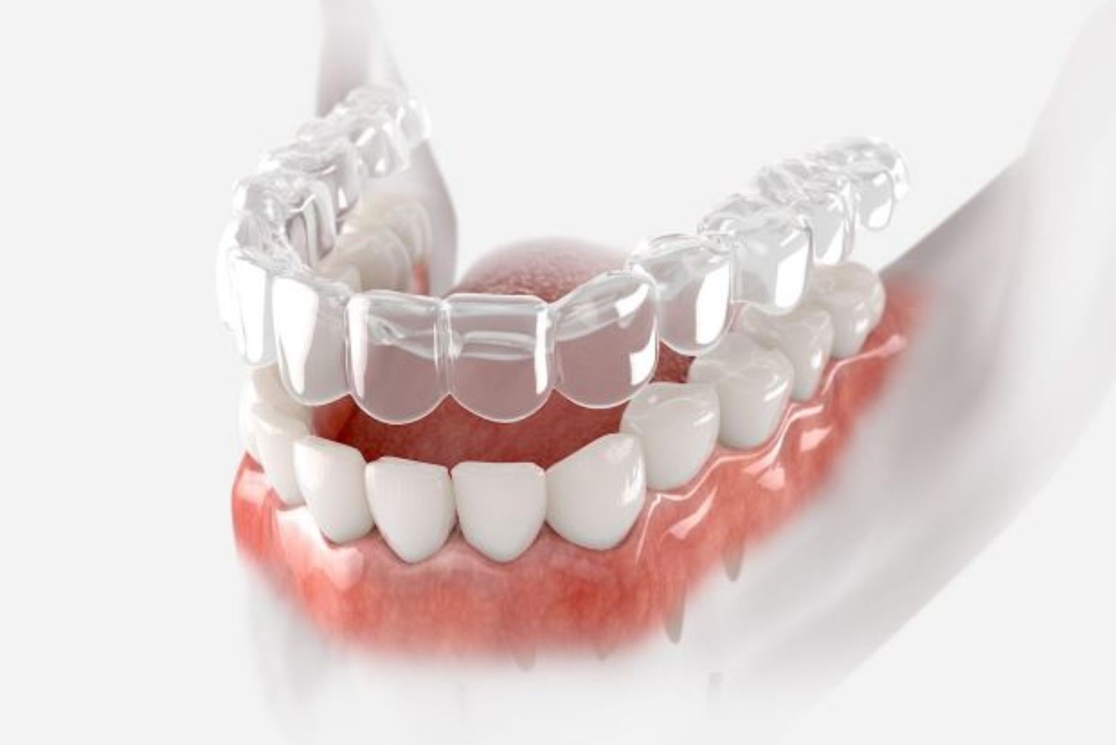 Clear Aligners
