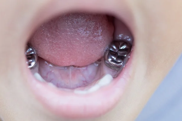 How Long Do Dental Crowns Typically Last on Baby Teeth? 1 Baby Tooth with a Crown