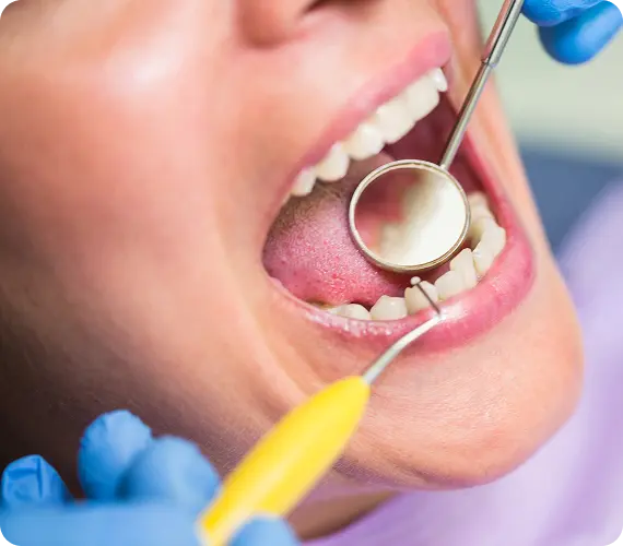 Tooth Coloured Fillings