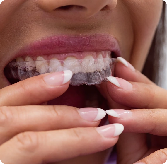 What Is Invisalign