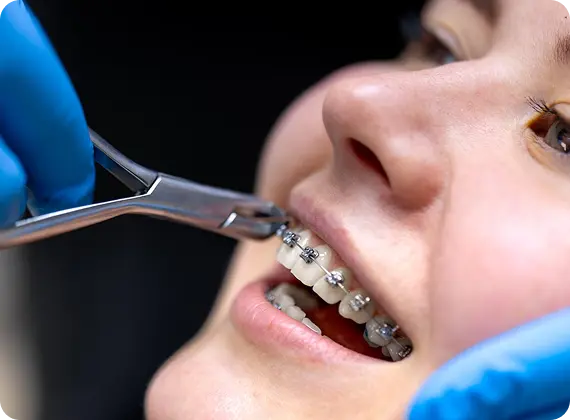 Why Metal Braces