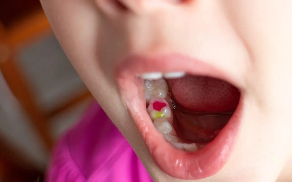 Tooth Coloured Fillings