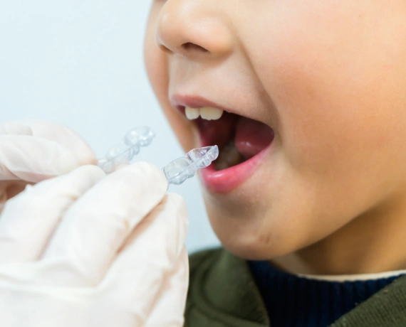 Why You Need a Retainer After treatment