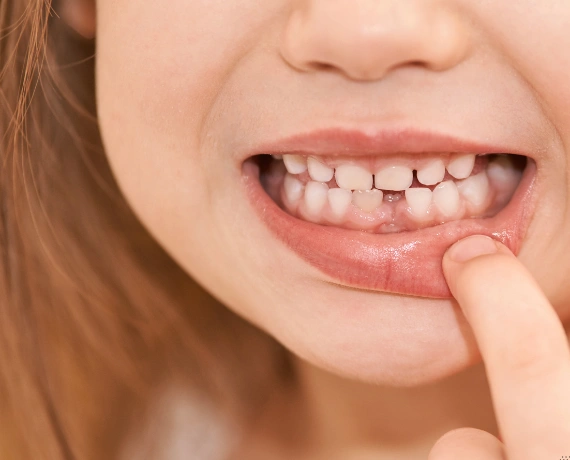 Why an Early Gap Is a Problem
